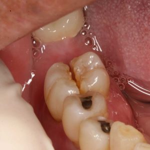 Tại sao răng bị nứt? Cách khắc phục răng nứt như thế nào?