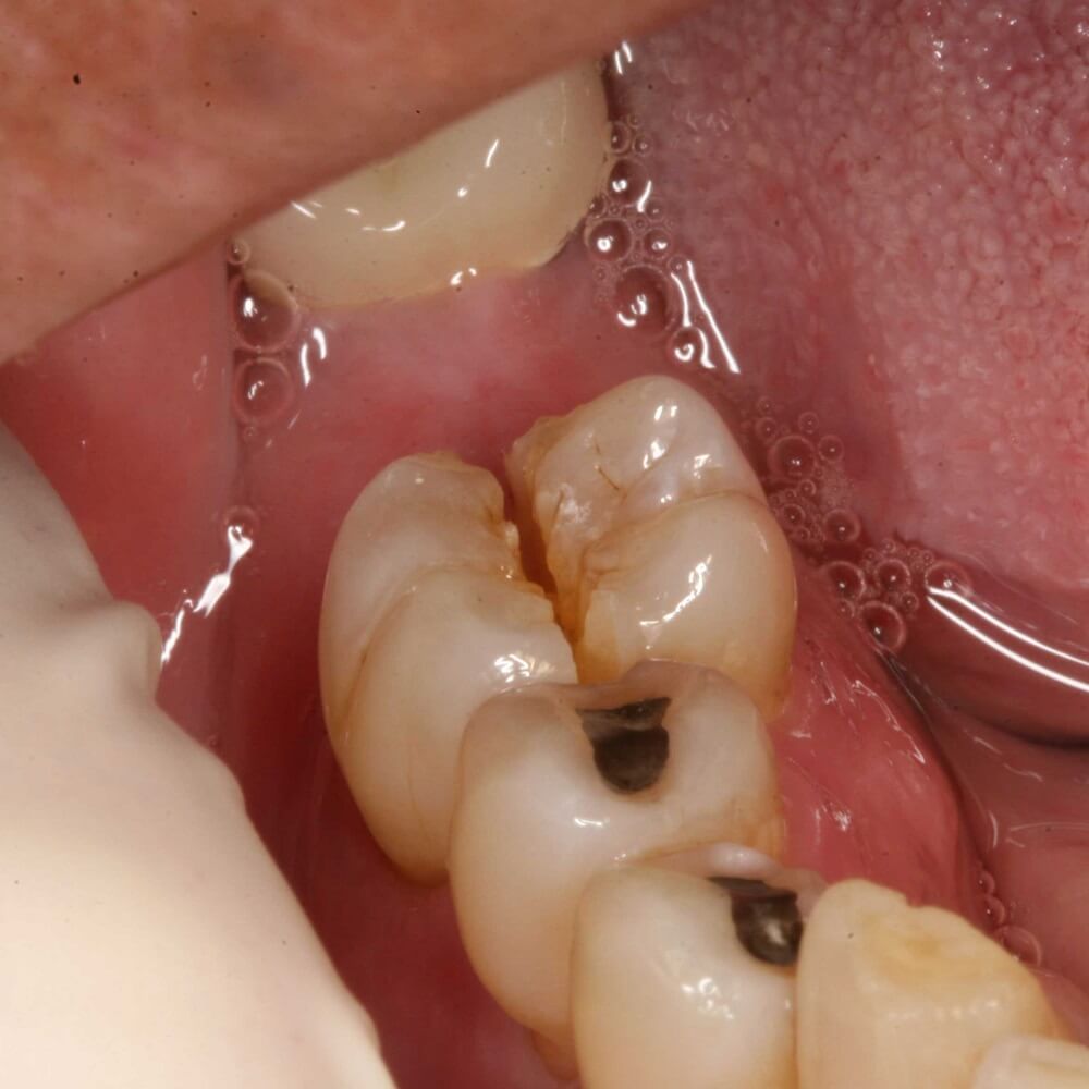 Tại sao răng bị nứt? Cách khắc phục răng nứt như thế nào?