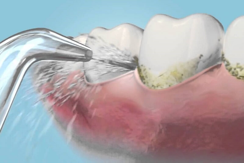 Bí quyết vệ sinh răng Implant giúp răng luôn chắc khỏe