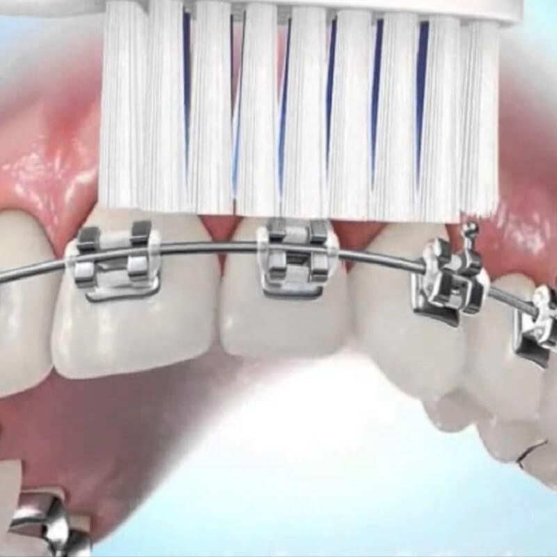 Mách bạn 5 cách vệ sinh răng niềng hiệu quả nhất