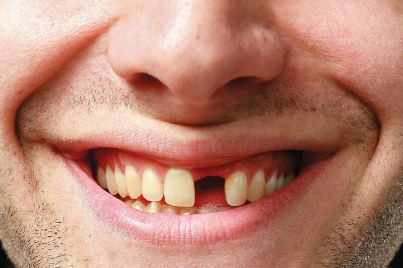 mất răng nhưng không trồng lại có ảnh hưởng gì không?