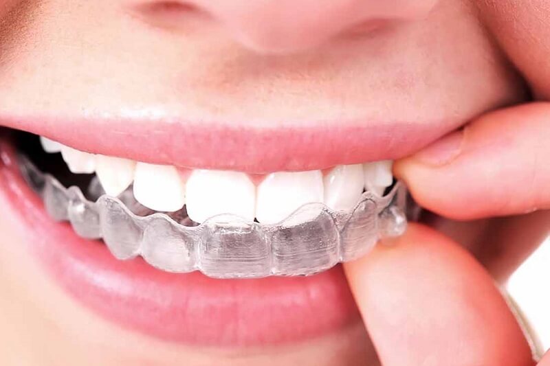 Niềng răng người lớn có điểm gì khác với niềng răng trẻ em?