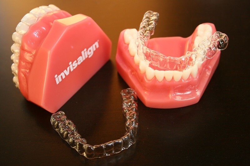 Niềng răng Invisalign – Đặc điểm và quy trình chỉnh nha tiêu chuẩn Phuong-phap-chinh-nha-nieng-rang-trong-suot-invisalign-1