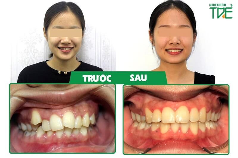 Khách hàng Tống Thị Chinh điều trị răng lệch lạc