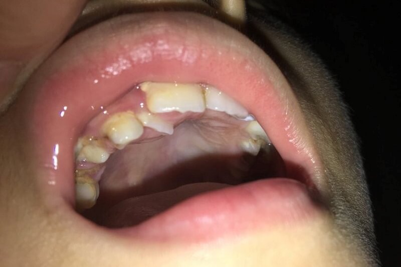 Răng vĩnh viễn mọc lên trước khi nhổ răng sữa khiến răng mọc lẫy