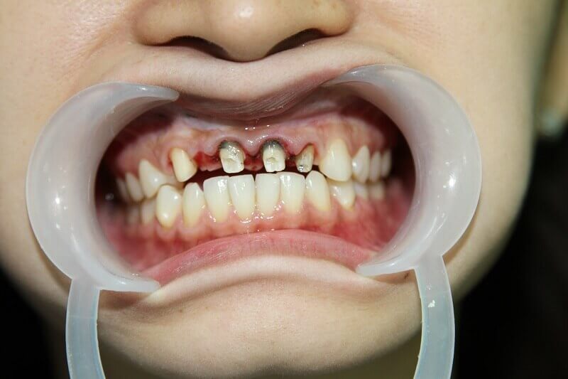 Răng sứ hỏng là do đâu và cách khắc phục như thế nào?