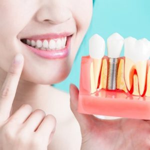 Thời gian bao lâu để hoàn cấy trồng răng Implant