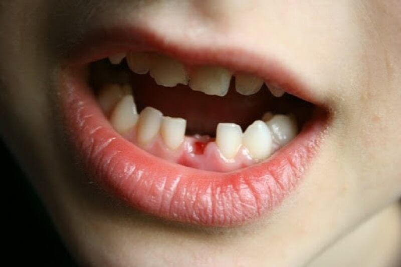 Lưu ý đến trường hợp nên và không nên trồng răng Implant