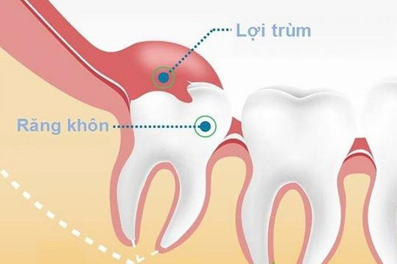 3 dấu hiệu nhận biết răng khôn mọc lệch nhất định phải biết