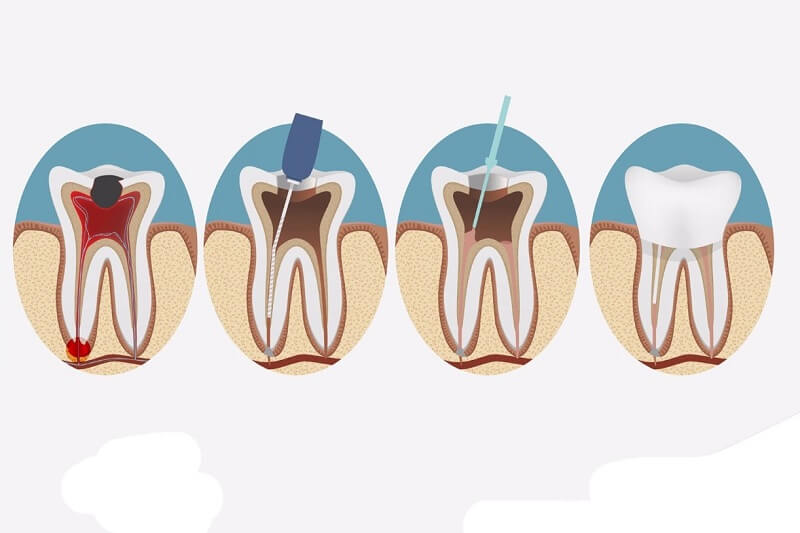 Tại sao cần bọc răng sứ cho răng chữa tủy?