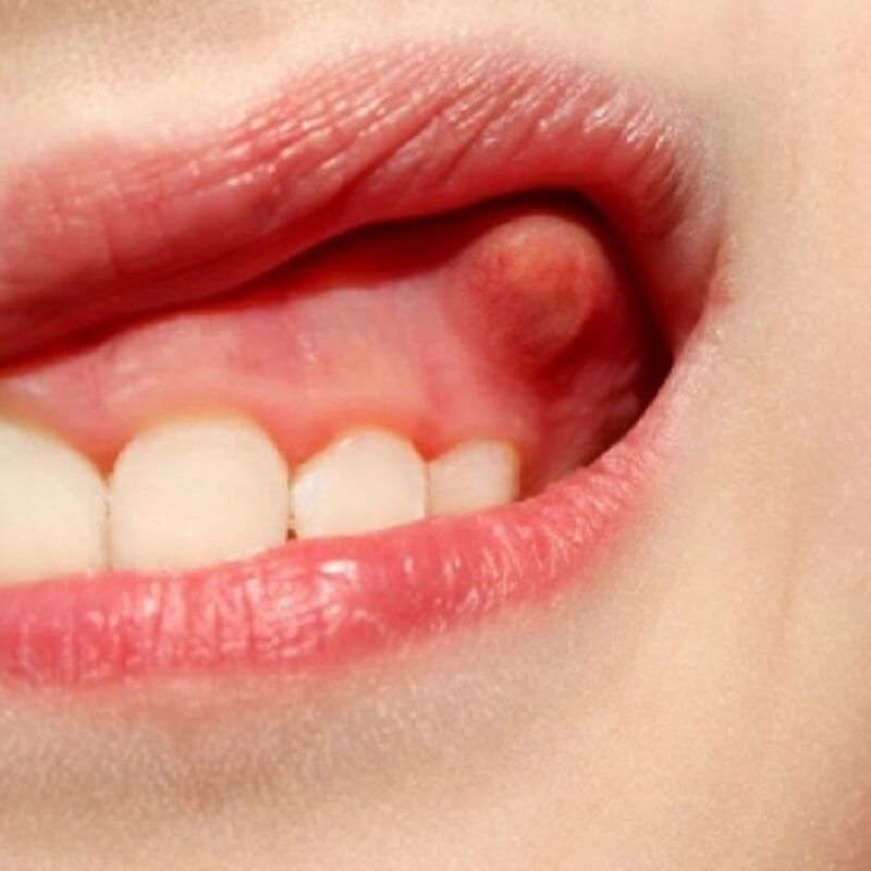 Áp xe răng là gì? Áp xe răng có nguy hiểm không?