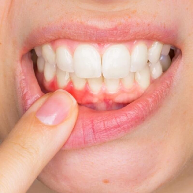 Bọc răng sứ bị viêm lợi phải khắc phục như thế nào?
