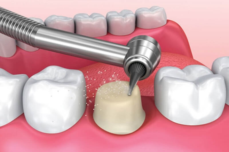 Bọc răng sứ bị viêm lợi phải khắc phục như thế nào?