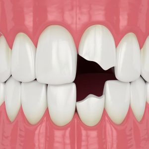 Bọc răng sứ cho răng sứt mẻ có hiệu quả không?