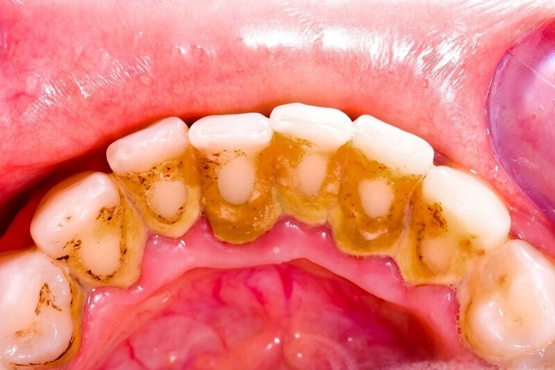 Chân răng bị mục phải làm sao để khắc phục?