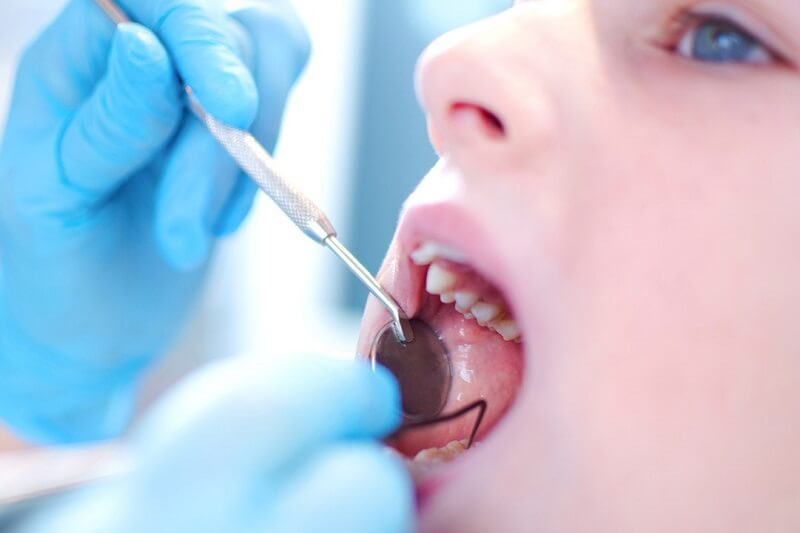 Có nên lấy cao răng cho trẻ em không?