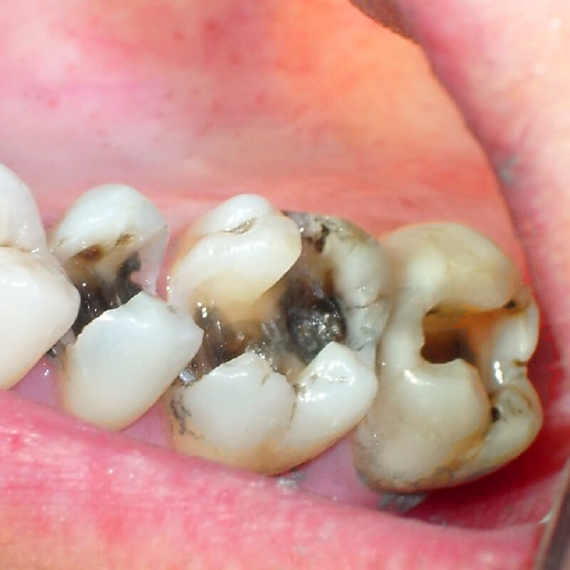 Điều trị sâu răng ở người lớn hiệu quả