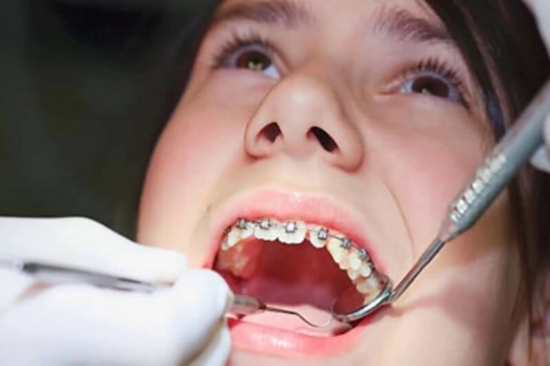 Hóp má khi niềng răng – Nguyên nhân và cách khắc phục