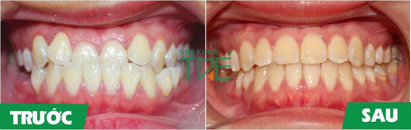Hóp má khi niềng răng – Nguyên nhân và cách khắc phục