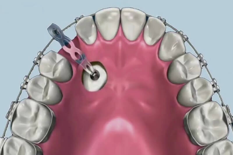 Răng nanh mọc ngầm trong xương hàm khắc phục như thế nào?
