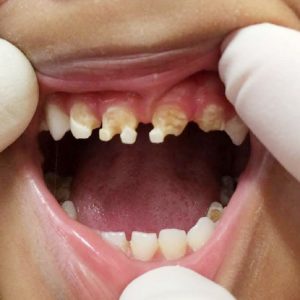 Sún răng ở trẻ: Nguyên nhân và cách phòng tránh hiệu quả