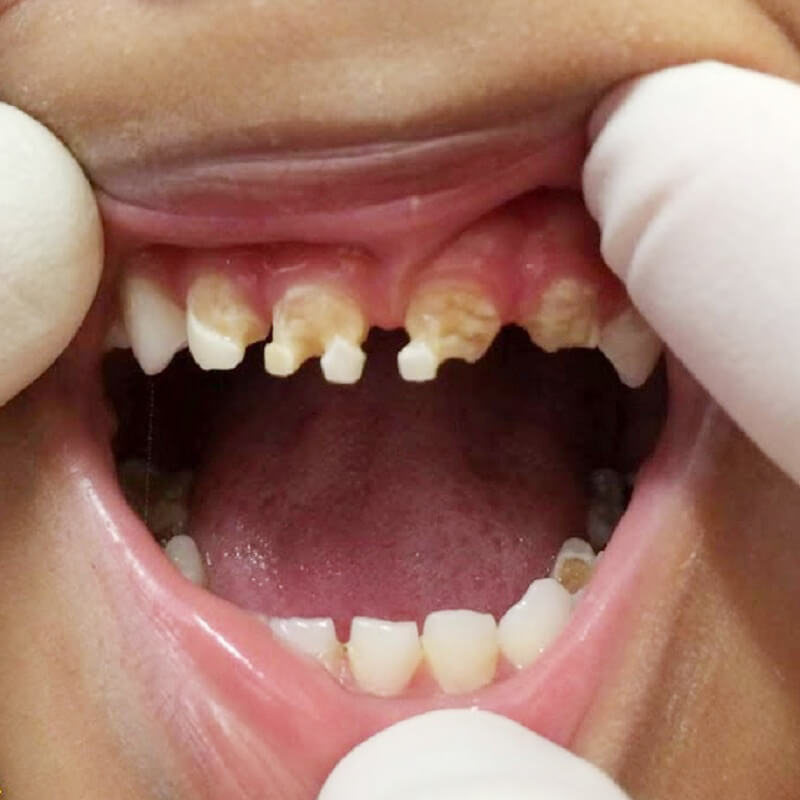 Sún răng ở trẻ: Nguyên nhân và cách phòng tránh hiệu quả