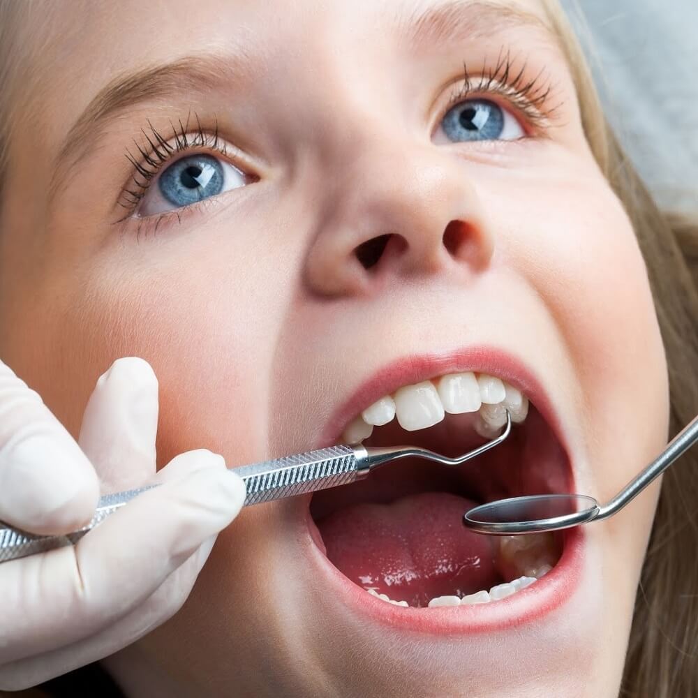 Những điều cần biết khi niềng răng Invisalign cho trẻ