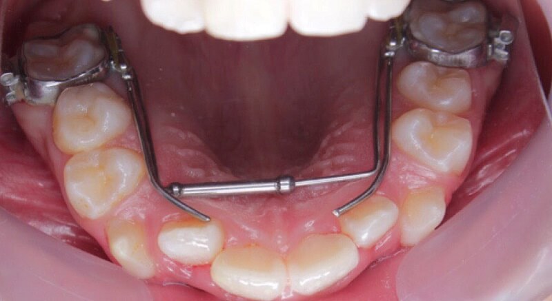 Trường hợp nào phải nong hàm khi niềng răng?