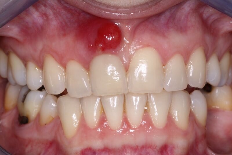 Viêm chân răng: Nguyên nhân và cách điều trị dứt điểm