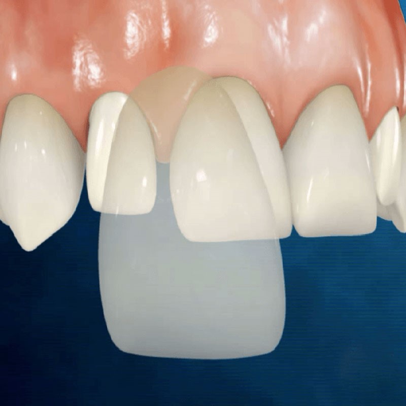  Bọc răng sứ 1 cái có được không - Lựa chọn tốt cho nha khoa hiện đại