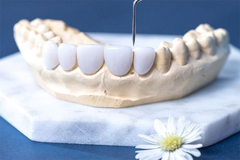 Bọc răng sứ Emax - NHA KHOA TRẺ