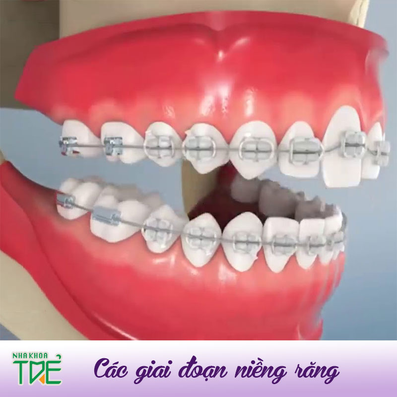 Các giai đoạn niềng răng cụ thể trong quá trình chỉnh nha