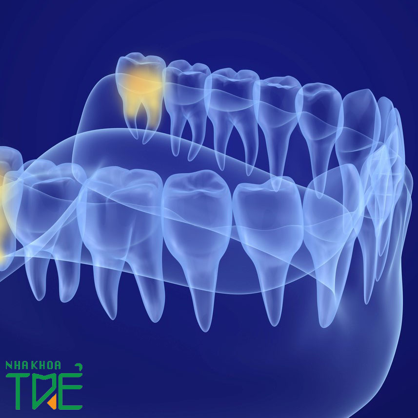 Giá nhổ 1 chiếc răng khôn bao nhiêu tiền? Bảng giá mới 2022