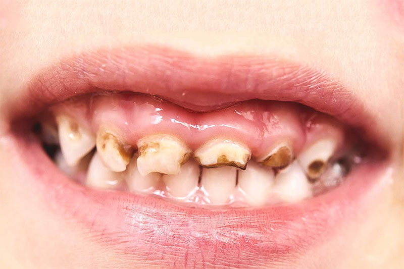Nguyên nhân răng trẻ em bị vàng và cách làm trắng răng an toàn cho trẻ