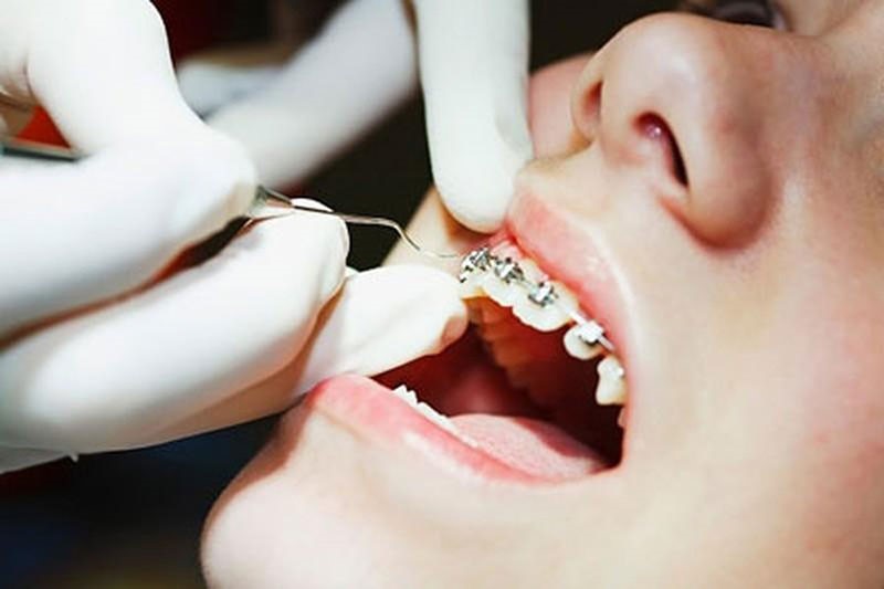 5 vấn đề thường gặp khi niềng răng mắc cài