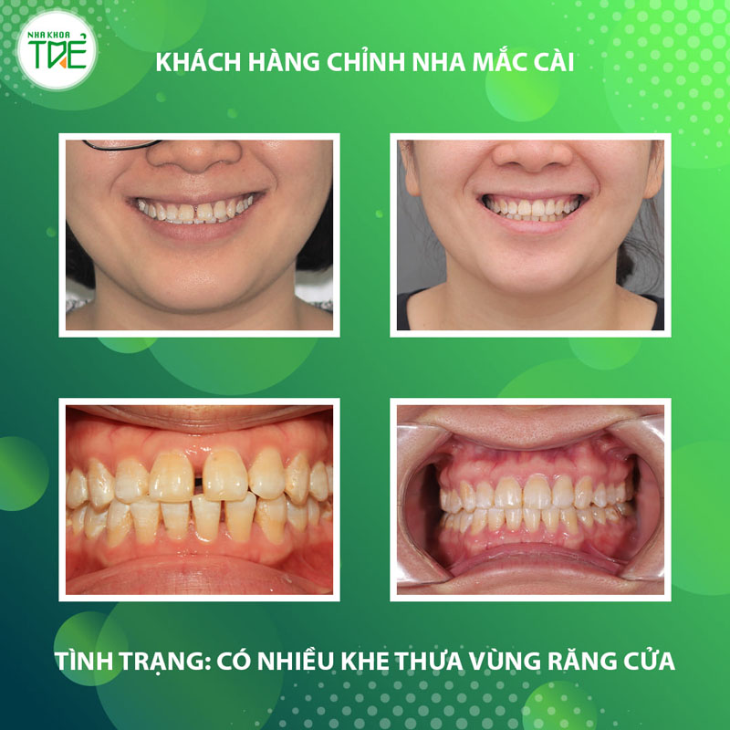 Niềng răng khắc phục nhiều khe thưa vùng răng cửa