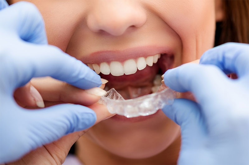 Niềng răng Invisalign có nhổ răng không? Nếu nhổ có nguy hiểm không?