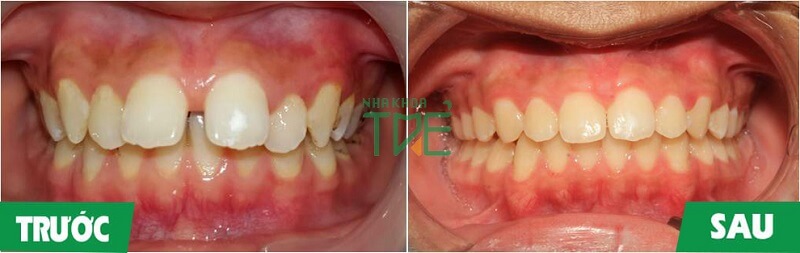 Niềng răng thưa để khắc phục khuyết điểm của hàm răng