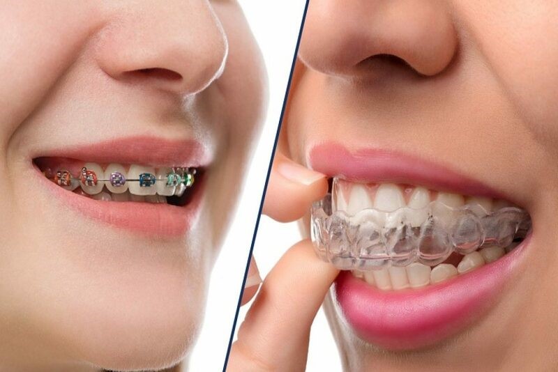 Hai phương pháp niềng răng cho trẻ em ở giai đoạn 12 -16 tuổi