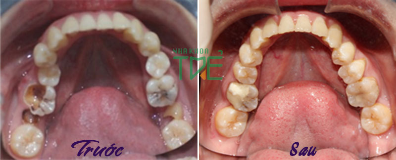 Hình ảnh niềng răng (trước và sau khi điều trị răng sâu và chỉnh nha)
