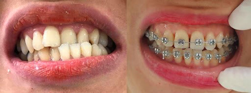 Tại sao phải nâng khớp cắn khi niềng răng?