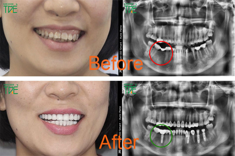 Trồng răng Implant có gây hại cho sức khỏe cơ thể không?