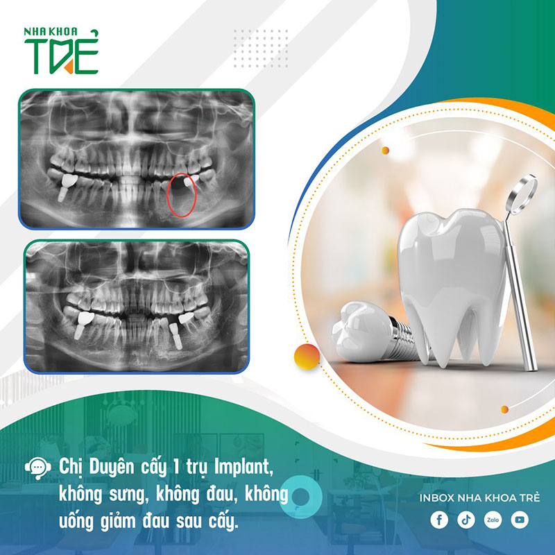 Trồng răng Implant Hà Nội không đau, không sưng