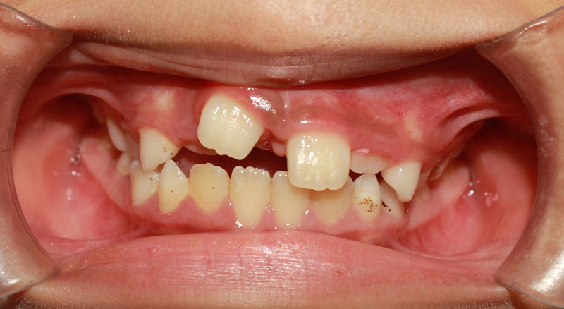 Biến chứng răng mọc ngược và cách xử lý hiệu quả