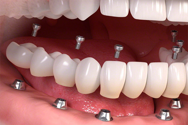 Cấy ghép Implant All On 6, All On 4 giúp phục hình răng toàn hàm hiệu quả
