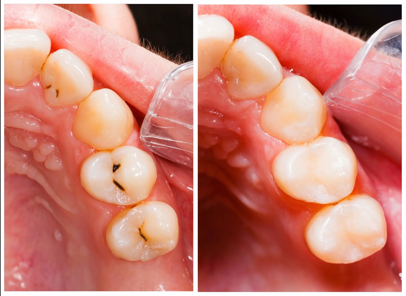 Hàn trám răng sâu khắc phục tình trạng đau nhức, tránh viêm tủy răng