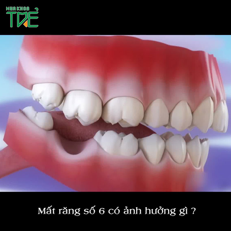 Hậu quả mất răng số 6 sớm? Trồng răng khắc phục mất răng hàm như thế nào?