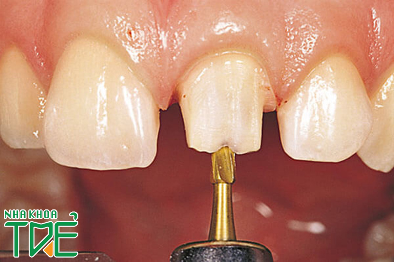 Kỹ thuật mài răng không tốt có thể gây ra ảnh hưởng rất lớn đến chiếc răng thật