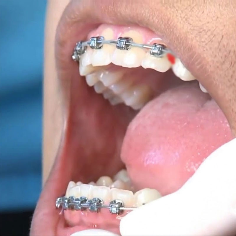 Niềng răng bị chảy máu nguyên nhân do đâu? Cách khắc phục như thế nào?