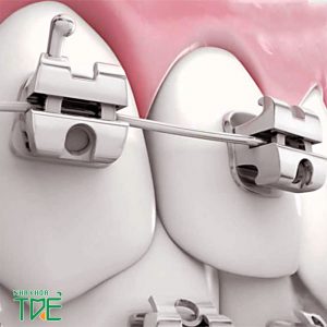 Niềng răng mắc cài kim loại tự buộc giúp chỉnh nha nhanh chóng, hiệu quả